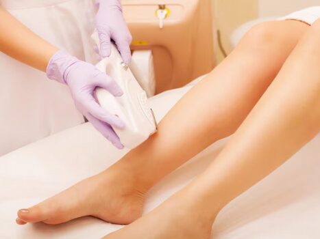 Laser hair removal